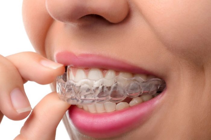 All You Need to Know About Teeth Aligners